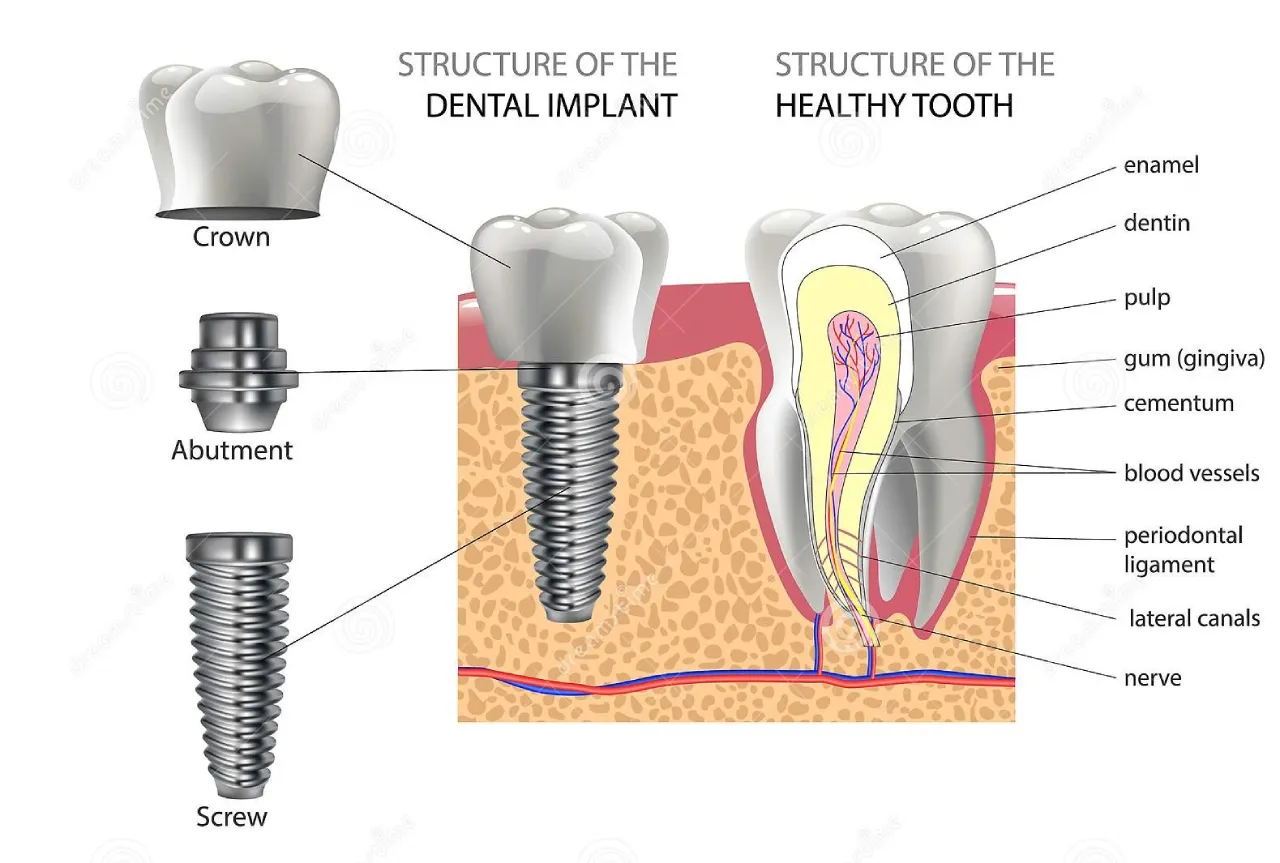 Dental Implant In Vadodara