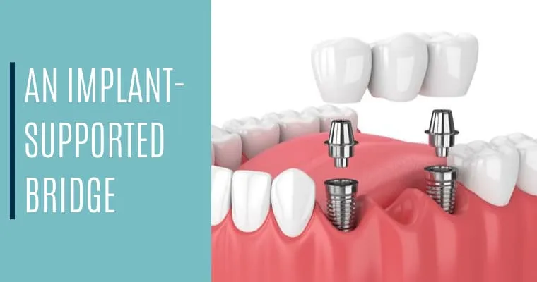 dental implant in Vadodara