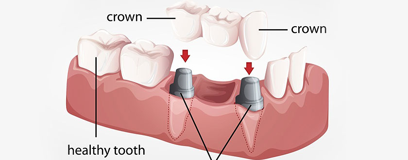 DENTAL BRIDGE IN VADODARA