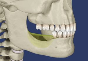  Jaw deterioration after removal of teeth 