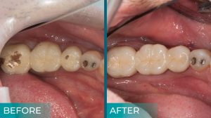 An image comparing PFM and zirconia dental crowns. The PFM crown is shown on the left and has a metal base with a layer of tooth-colored porcelain fused to the outside. The zirconia crown is shown on the right and is made entirely of a strong, tooth-colored ceramic material. 