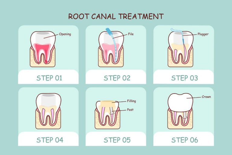 "An illustration showing the various steps involved in a root canal procedure, including the removal of infected tissue, shaping and cleaning of the canal, and filling and sealing of the tooth."
