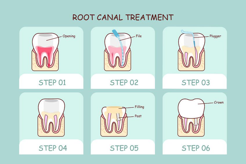 "An illustration showing the various steps involved in a root canal procedure, including the removal of infected tissue, shaping and cleaning of the canal, and filling and sealing of the tooth."