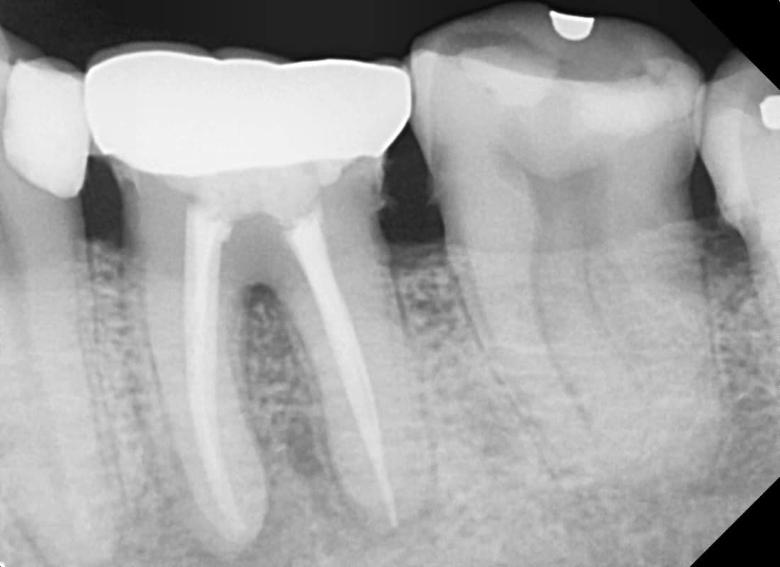 root canal treatment in Vadodara