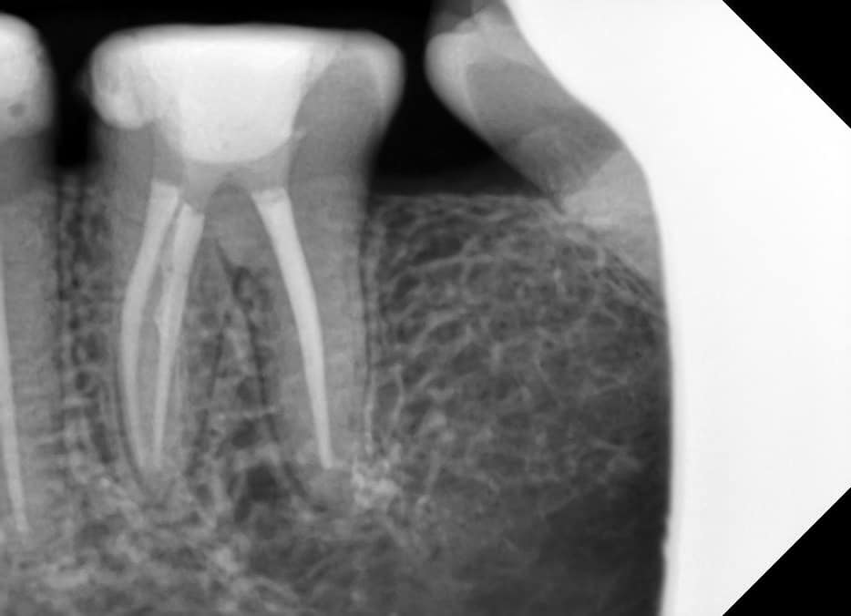 Root canal treatment in Vasna Bhayli , vadodara