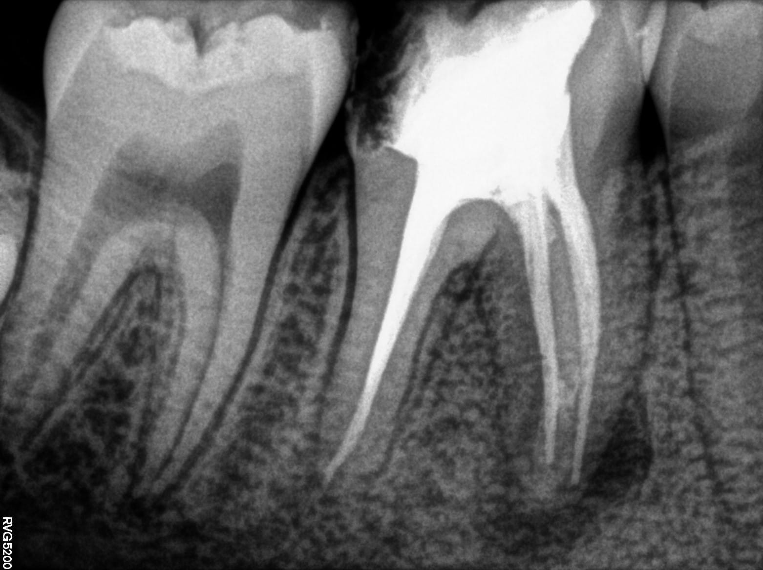 Root canal treatment in Vasna road, Vadodara