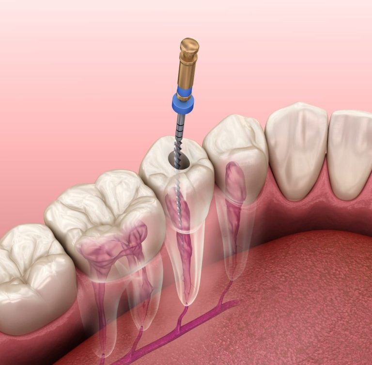 "A dentist inserting a thin, spiral-shaped dental file into a patient's tooth during a root canal procedure."