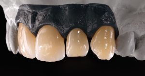 "An image of an Emax crown, which is a type of dental crown made from a strong, tooth-colored ceramic material. The crown is shown from the front and appears to fit snugly over a natural tooth. It has a smooth, glossy surface and a lifelike translucency that mimics the appearance of a real tooth.