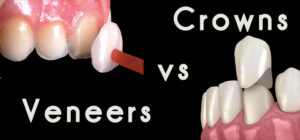 Comparison of dental veneers and dental crowns. The image shows a veneer placed on a front tooth and a crown that covers the entire tooth. The veneer is thin and designed to improve the appearance of the tooth, while the crown is a cap that restores the function and strength of the tooth.