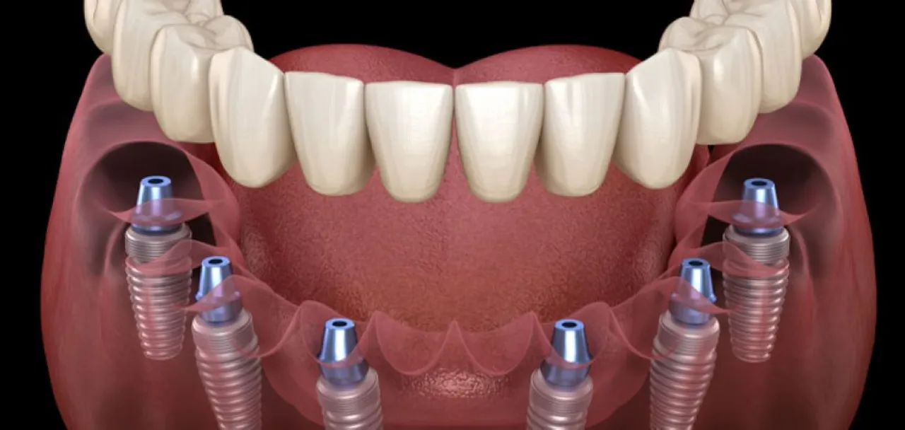 All on 6 dental Implant In Vadodara