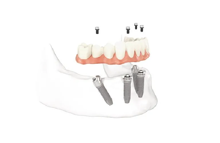 All on 4 dental Implant