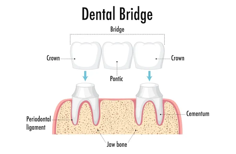 Dental Bridge In Vadodara