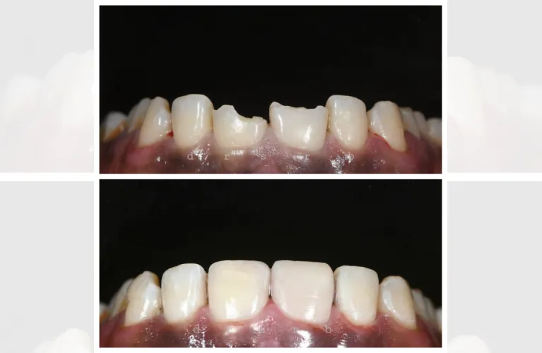 Dental Filling | Tooth Colour Filling in Vadodara