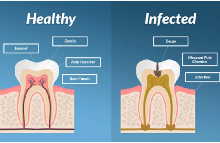 Root Canal Treatment in Vadodara