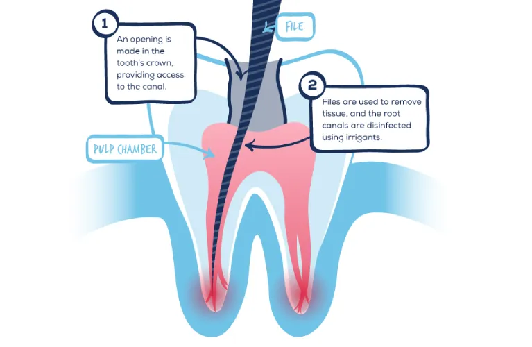 Root Canal Treatment in Vadodara