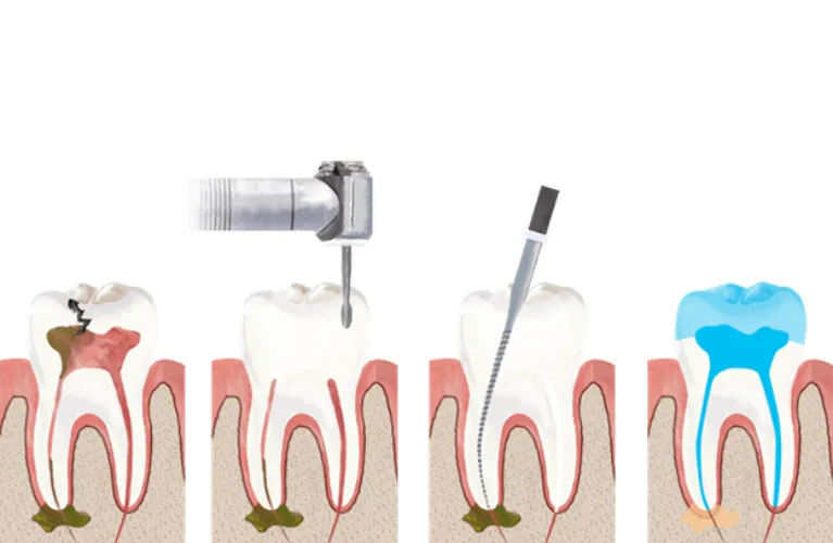 Root Canal Treatment in Vadodara