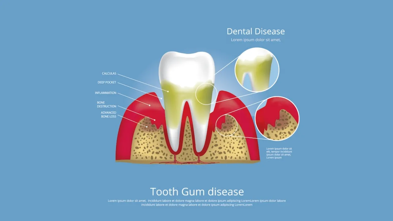 periodontitis | Advanced gum disease treatment n Vadodara