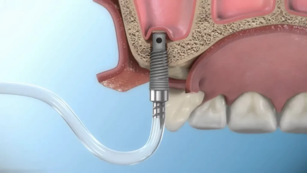 indirect sinus lift in vadodara