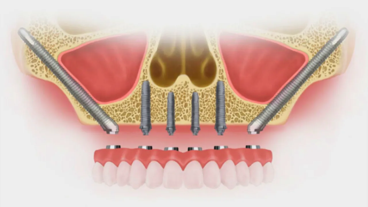 Zygoma and Pterygoid Dental Implant in Vadodara