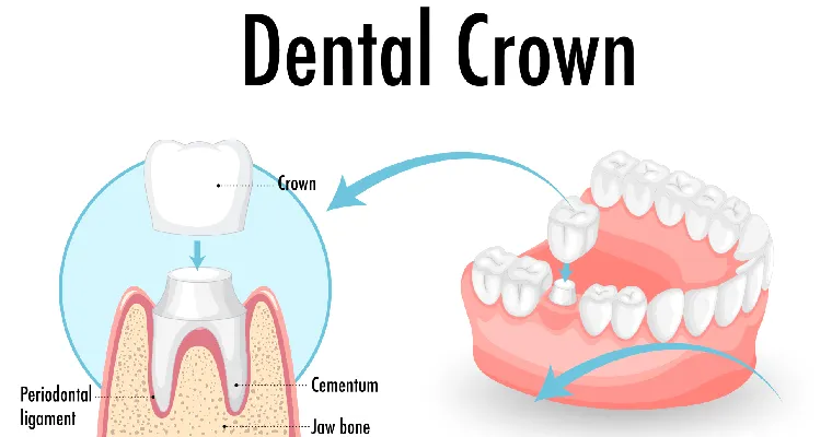 Dental Crown Treatment in Vadodara