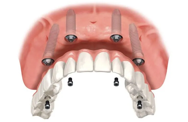All on 4 Dental implants in Vadodara