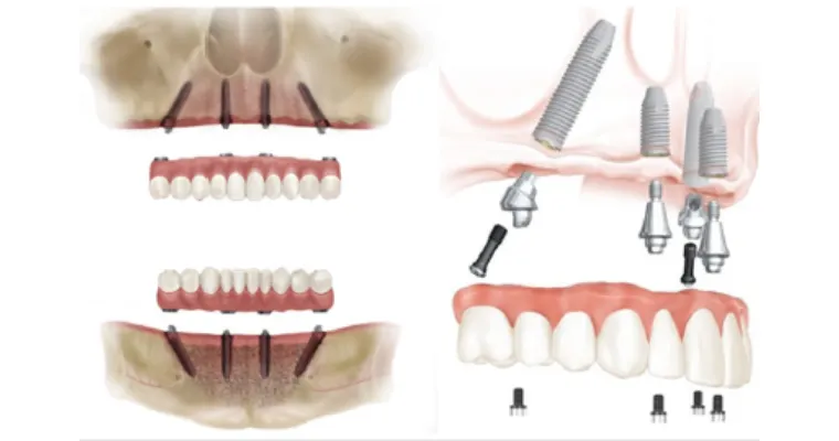 All on 4 Dental implants in Vadodara