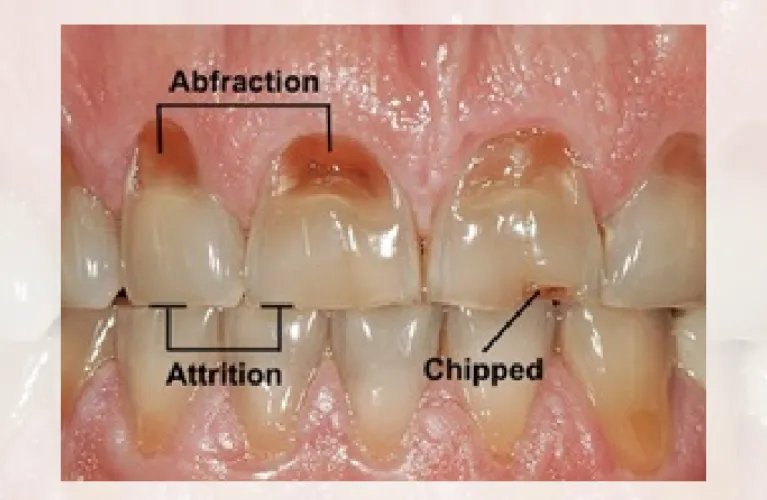 Bruxism | Teeth Clenching | TMD | TMJ disorder | TMJ dentist i Vadodara