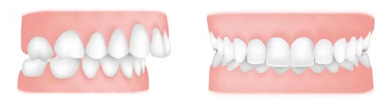 Orthodontic Treatment for Overjet (Overbite) - Rubber Bands 