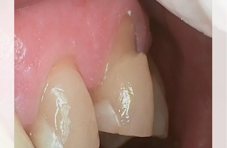 Bruxism | Teeth Clenching | TMD | TMJ disorder | TMJ dentist i Vadodara