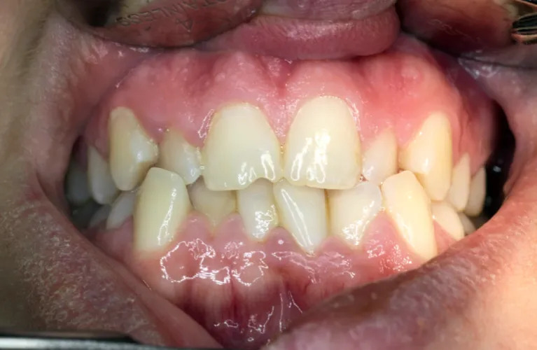 Teeth Crowding treatment in Vadodara