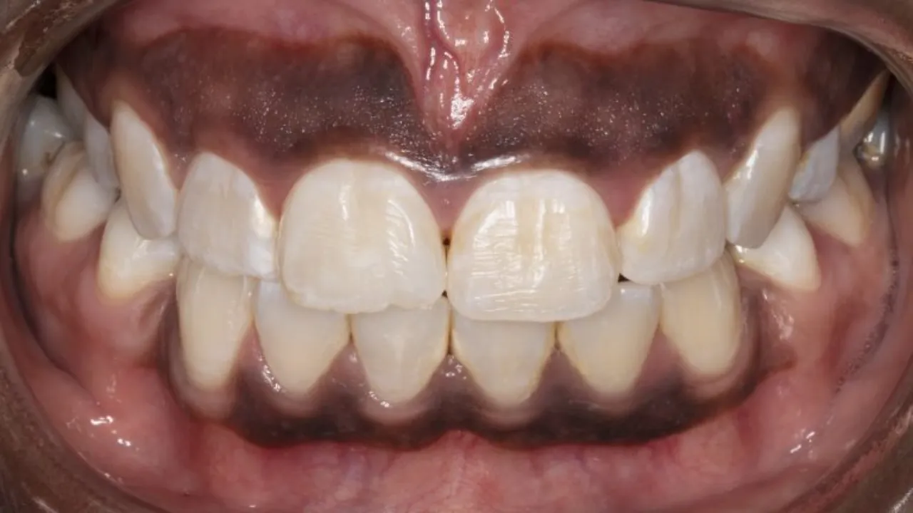 Periodontal Plastic Surgery - Removal of Amalgam Tattoos - Dental Online  College