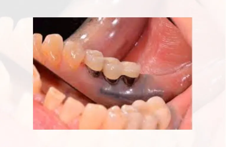 Gum disease | Black Gu Treatment in Vadodara