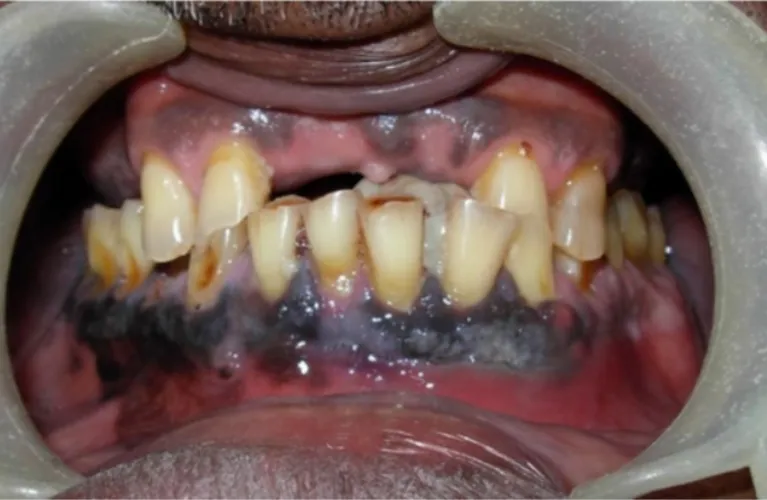 Gum disease | Black Gu Treatment in Vadodara