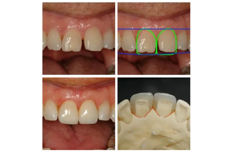 Dental Veneer In Vadodara