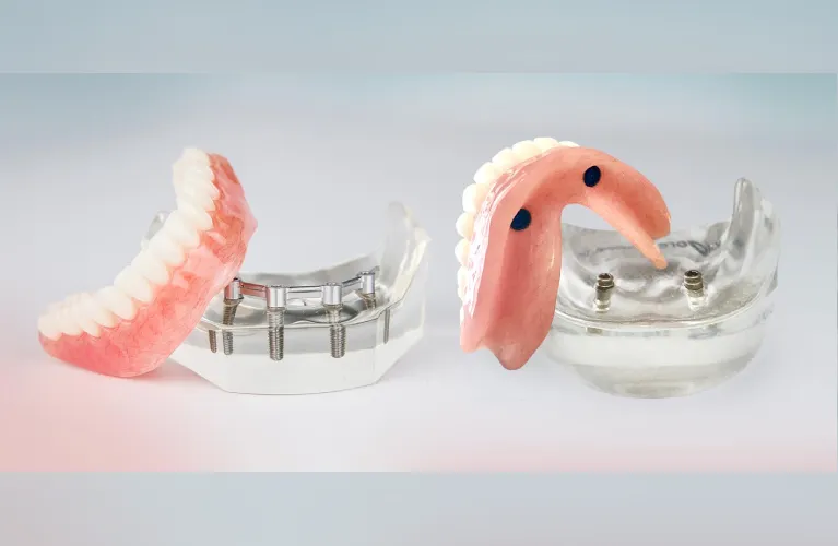 Denture on Implant | Implant Supported Denture in Vadodara