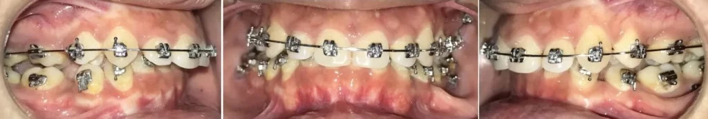 Overbite treatment of Metal Braces in Vadodara