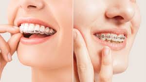 Metal Braces vs Clear Aligner