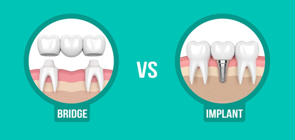 Dental Implants vs. Dental Bridges