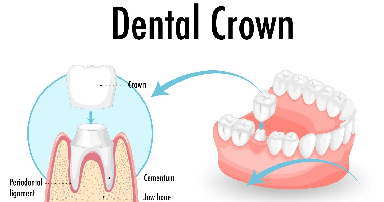 dental crown in vadodara