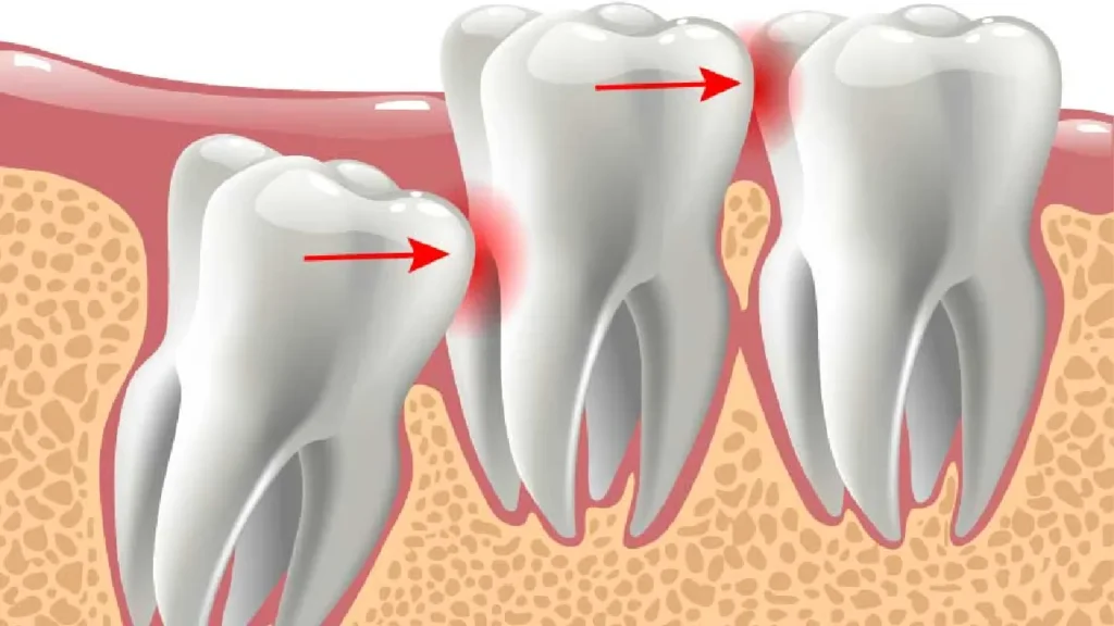 wisdom tooth removal