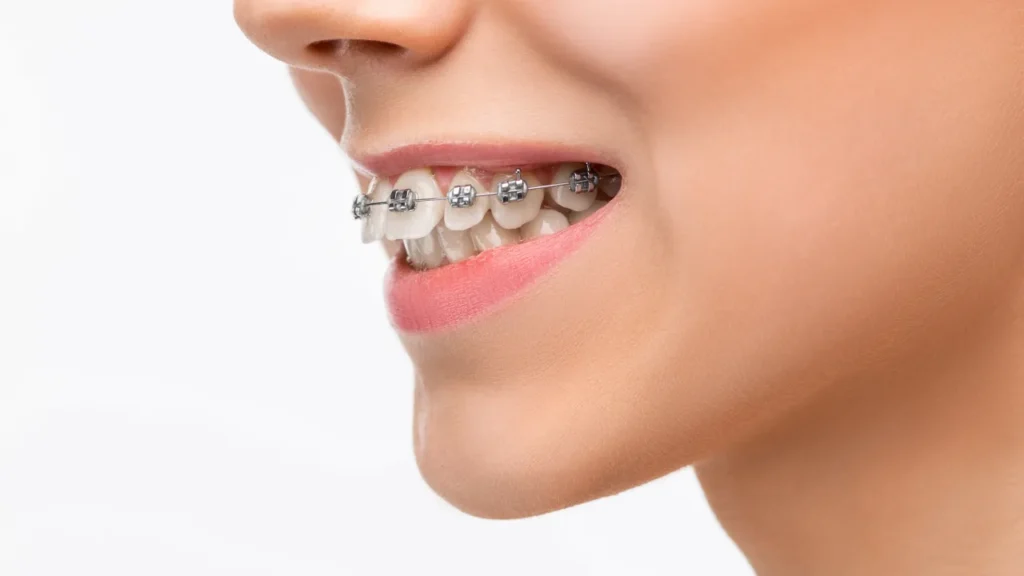 braces treatment in vadodara