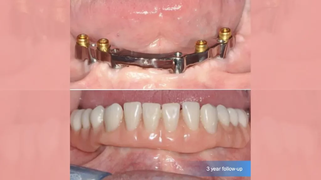 bar retained overdenture