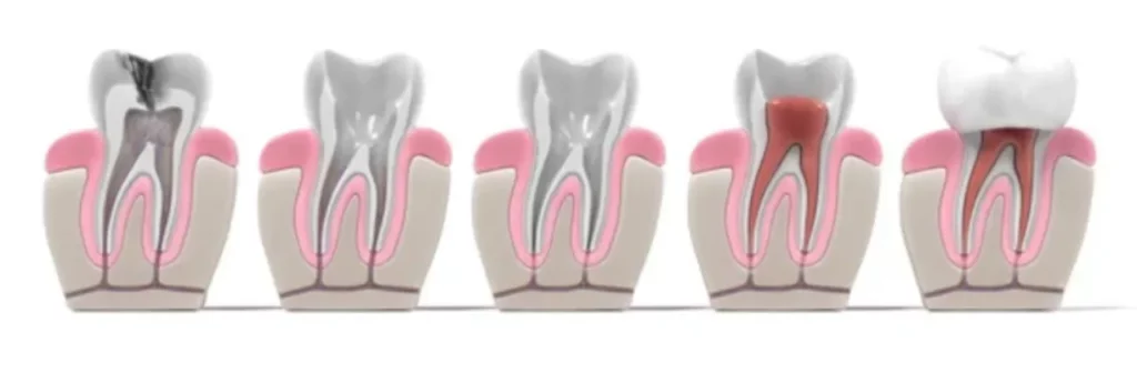 single sitting root canal treatment