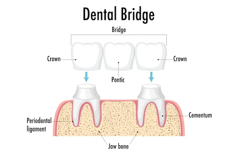 dental bridge