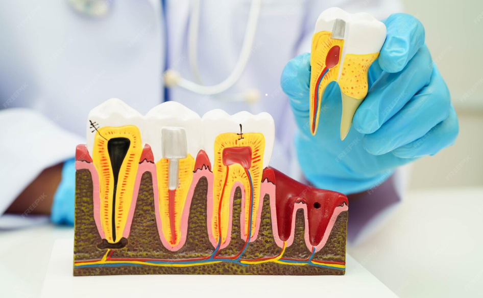 Root Canal Treatment - RCT In Bhayli , Vadodara