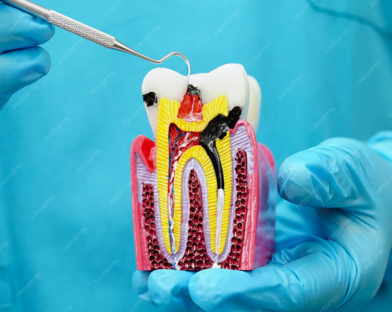 Painless Root Canal Treatment In Bhayli