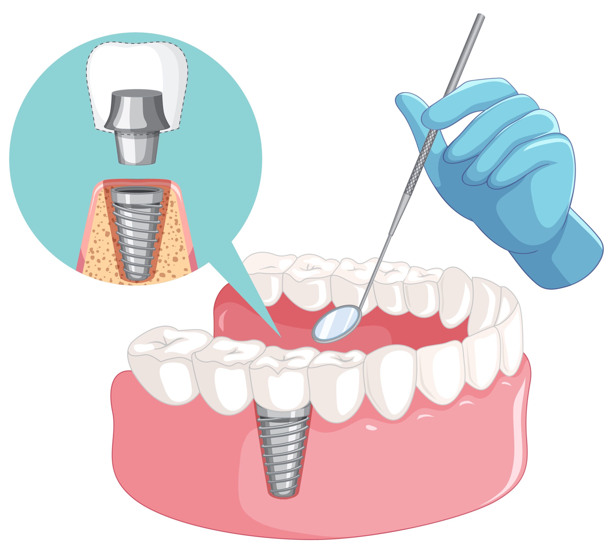 Dental Implant in Tandalja