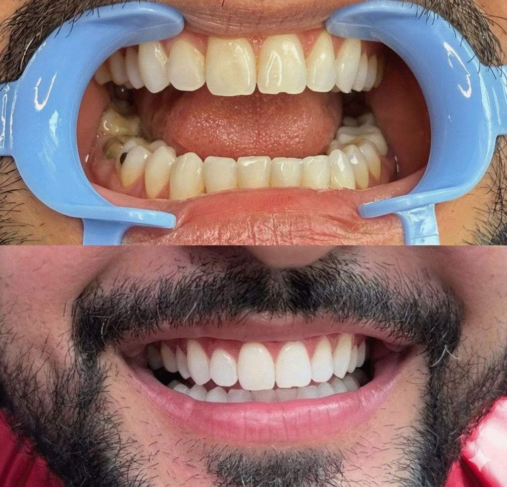 Happy Patient with His Teeth Whitening Result in vadodara